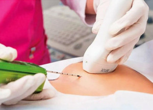 Биопсия молочной железы