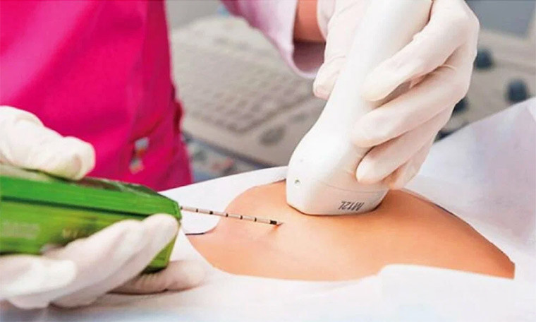 Биопсия молочной железы